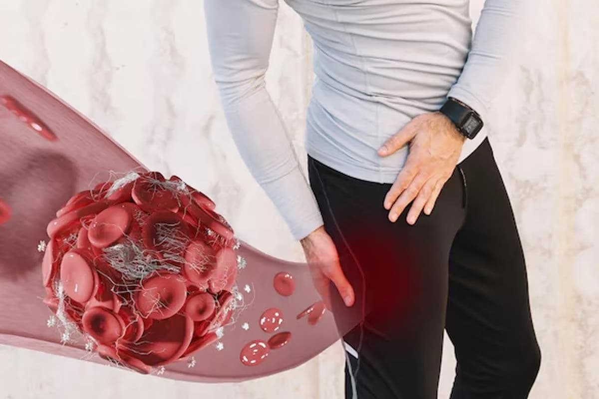 لخته شدن خون در پا چه خطراتی دارد؟ از عوارض مزمن تا مرگ ناگهانی