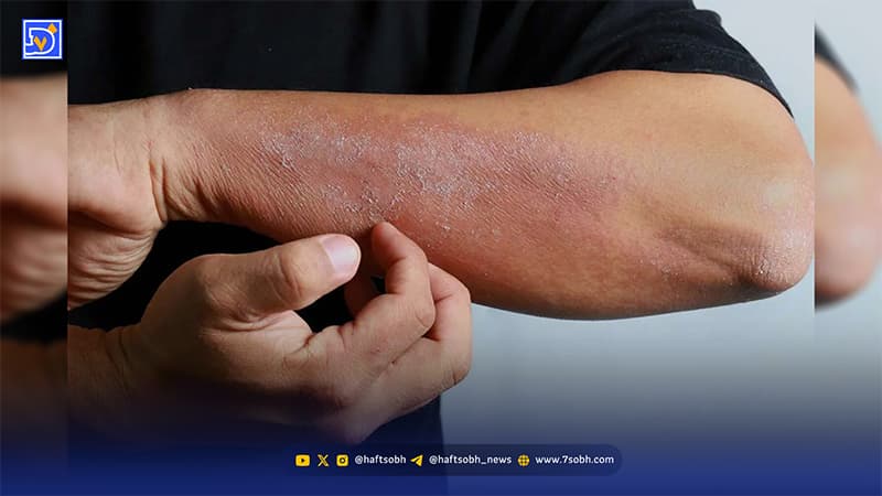 بهترین دارو برای خارش بدن؛ از آنتی‌هیستامین‌ها تا درمان‌های موضعی