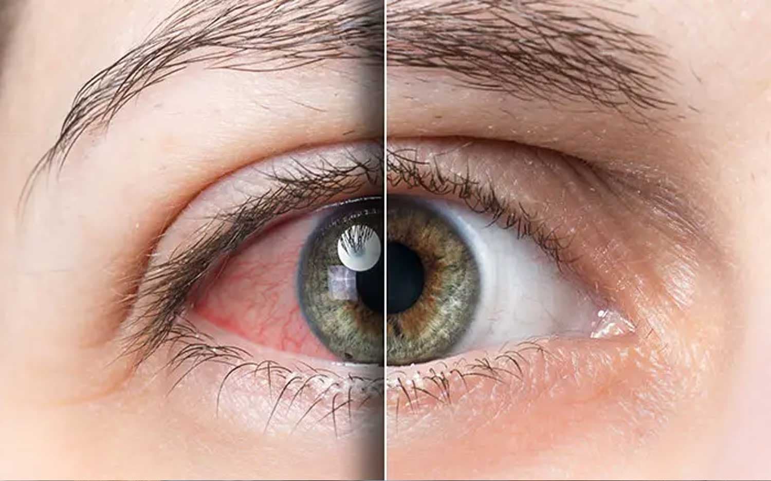 چگونه از خشکی چشم در هوای سرد زمستان پیشگیری کنیم؟