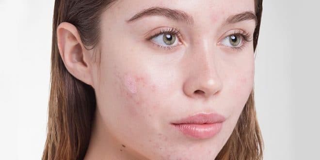 چیکار کنیم جوش نزنیم؟ + راهکار